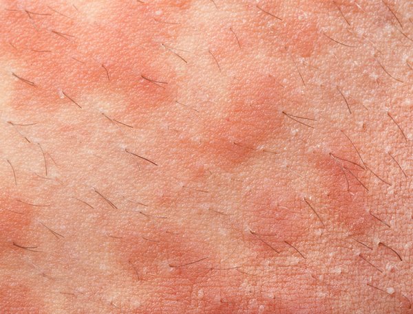 Eczéma oreille : comment apaiser les irritations naturellement